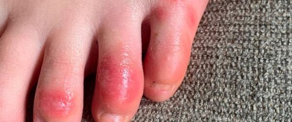 Decoloración en los dedos de los pies de un paciente adolescente al inicio de la afección denominada informalmente "dedos COVID".