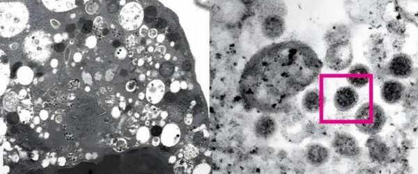 Micrografía de una célula de riñón de mono (Vero E6) tras la infección con la variante ómicron del SARS-CoV-2 que muestra el daño celular con vesículas hinchadas que contienen pequeñas partículas virales negras y a la derecha.