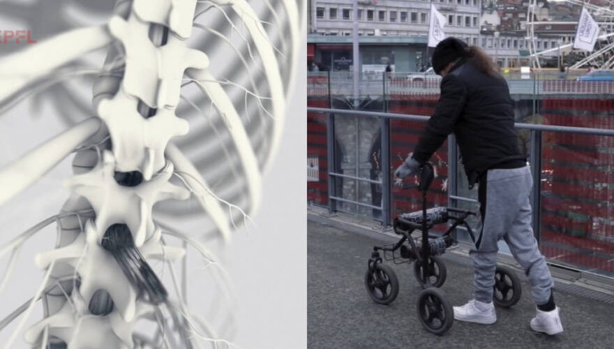 Implante permite a tres parapléjicos volver a caminar