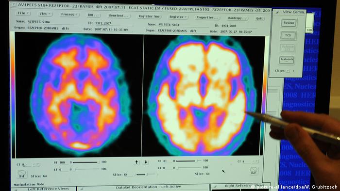 Imágenes en computador de una persona sana (izq.) y otra con Alzheimer.